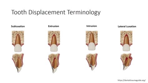 Dentoalveolar trauma - YouTube