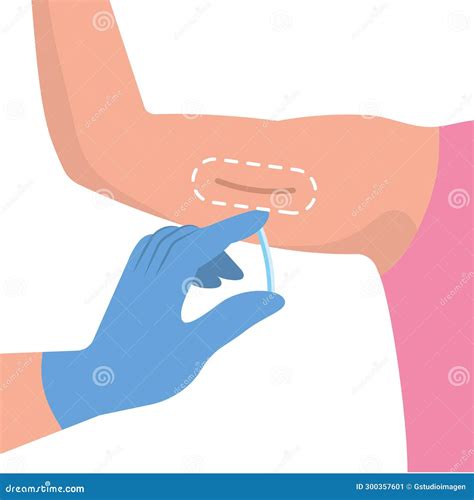 Contraceptive Implant Birth Control Stock Illustration - Illustration of hormonal, skin: 300357601