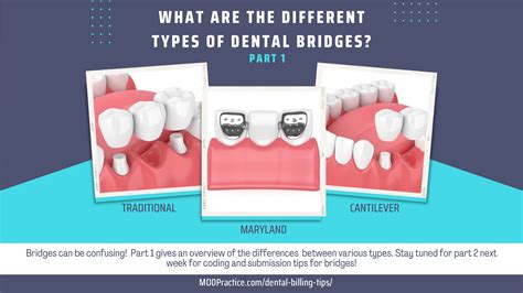 DIFFERENT TYPES OF DENTAL BRIDGES – PART 1 – MODPractice