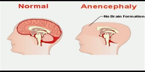 Anencephaly - Assignment Point