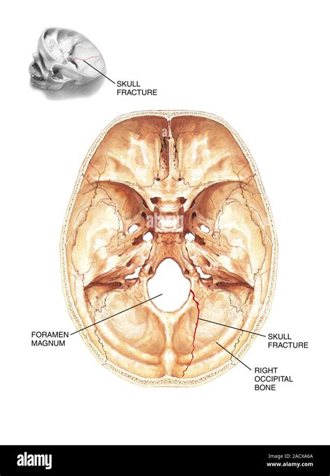 Fracture at base of skull. Labelled artwork of a linear fracture of the ...