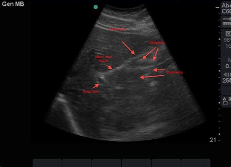 Porcelain Gallbladder ~ Ultrasound Cases Info