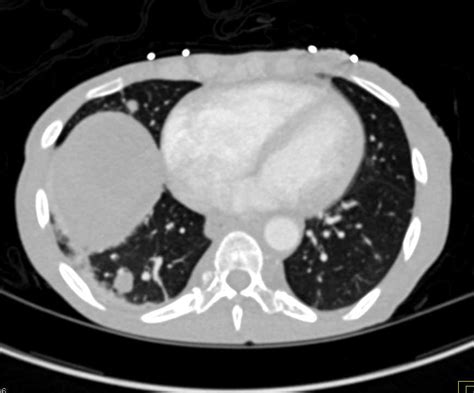 Pancreatic Cancer with Invasion of Portal vein and Porta Hepatis and Lung Metastases - Pancreas ...