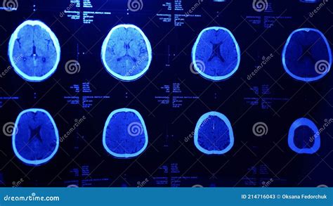 MRI of the Brain after Trauma Stock Image - Image of radiography, diagnostic: 214716043