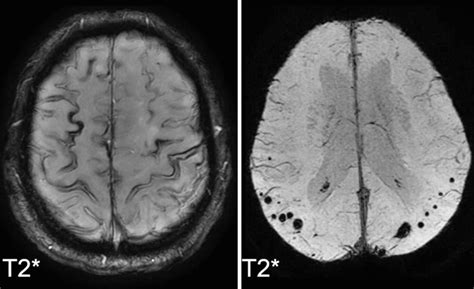 Fig. 11.6, [Superficial siderosis and lobar microbleeds...]. - Diseases of the Brain, Head and ...