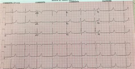 Dr. Smith's ECG Blog: Are these Wellens' waves?