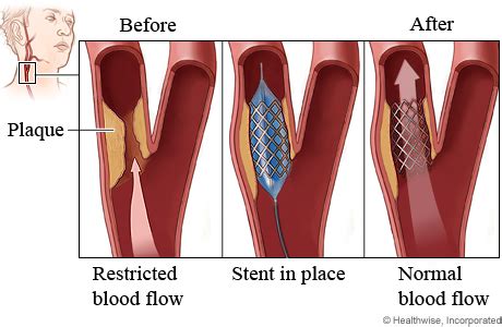 Carotid artery stenting | Cigna