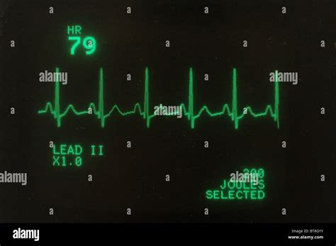 Heartbeat Monitor Hospital