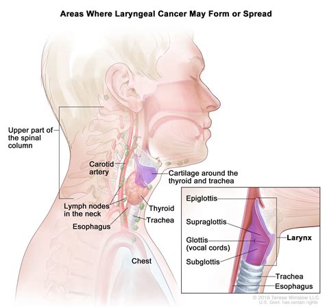 Laryngeal Cancer 101 : Symptoms, Causes, Stages & Treatment - Homage ...