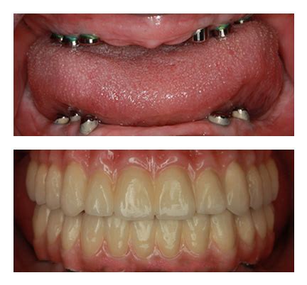 Cosmetic Dentistry Before & After Pictures - North Andover Dental Partners