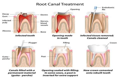 A Root Canal Dentist Can Treat Your Infected Tooth Nerves - St. George ...