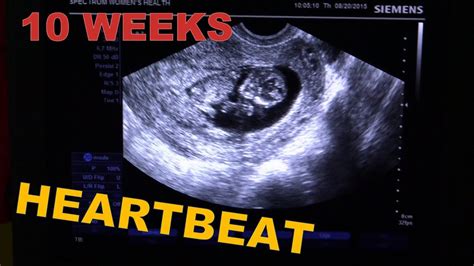 ️ 10 Weeks Pregnant Ultrasound + HEARTBEAT ️ Early Pregnancy USG -Baby ...