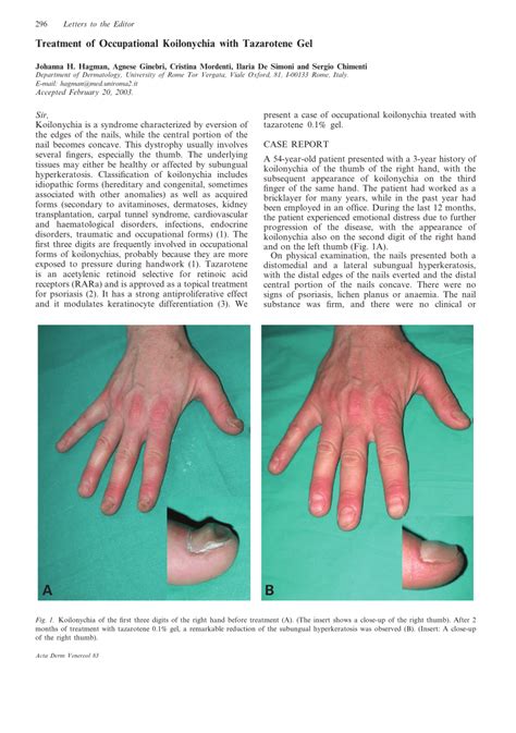 (PDF) Treatment of Occupational Koilonychia with Tazarotene Gel