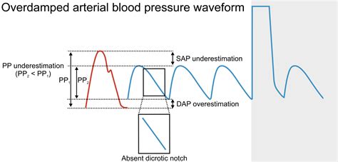 Understanding Damping in Arterial Line Monitoring – MED-TAC International Corp.