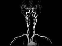 MRI Contrast Agent Die Lawsuit for Gadolinium Deposition Disease & Toxicity