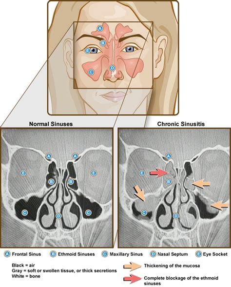 Fungal sinusitis | General center | SteadyHealth.com