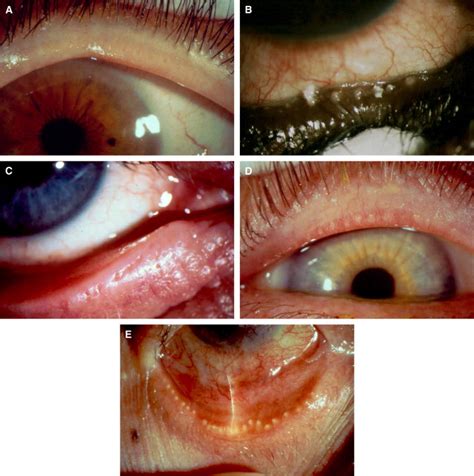 The Correlation Between the Tear Film Lipid Layer and Dry Eye Disease - Survey of Ophthalmology