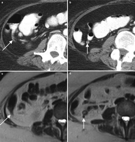 The Appendix | Radiology Key