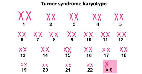 Turner Syndrome