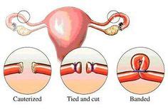 8 Sterilization ideas | female sterilization, fallopian tubes, birth control