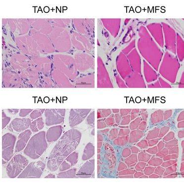 Clinical photograph showing ray amputation of the second and third ...