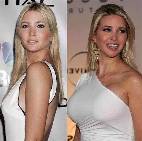 Ivanka Trump | Cirurgia plastica, Looks, Botox