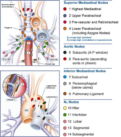 Regional lymph node stations for lung cancer staging [2] (with kind ...