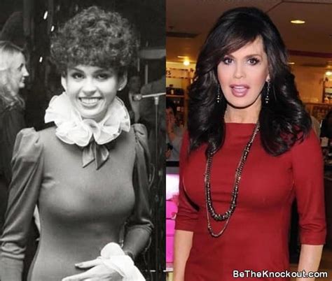 Marie Osmond Plastic Surgery Comparison Photos