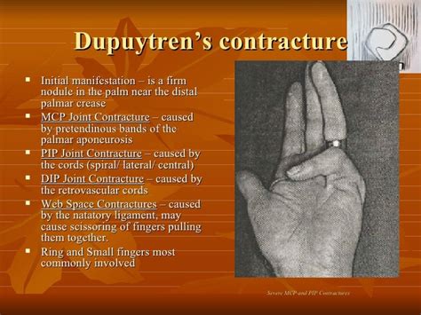 Dupuytrens Contracture