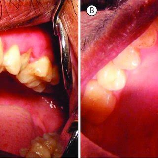 - An excised specimen of odontome | Download Scientific Diagram