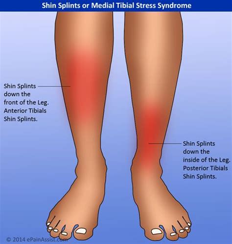 how to recognize shin splints | Pain in shins | Pinterest | Marathon training and Marathons