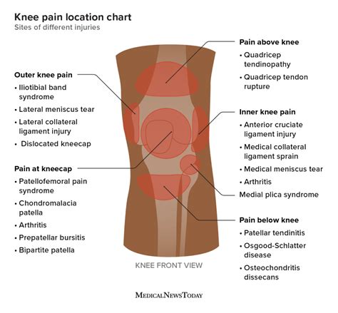 Knee pain location chart: Sites of different injuries