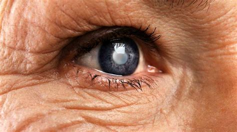 19 Warning Signs and Symptoms of Cataract Surgery Complications (Durin ...