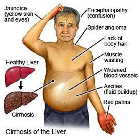 Cirrhosis of liver - MEDizzy