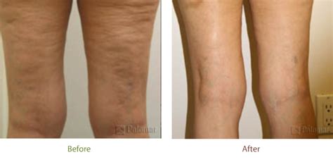 Laser Skin Tightening Before and After | El Dorado Hills