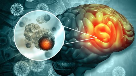 Tumor Otak: Penyebab, Gejala, Pengobatan, dan Biaya Operasi