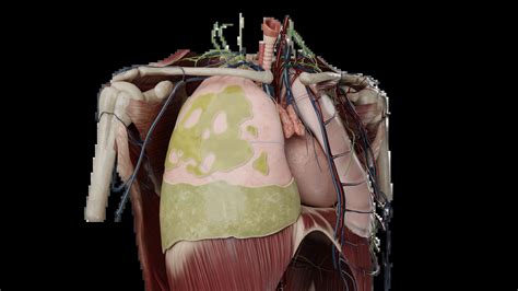 3D Model of Complications of Hemothorax | VOKA