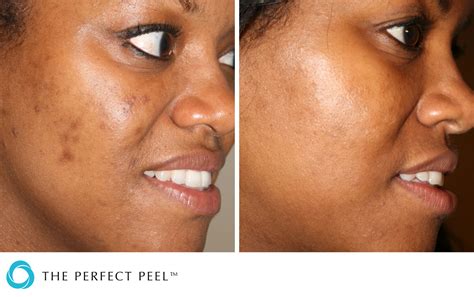 Chemical Peels - Perfect Peel® | Renew Medical Aesthetics - Cheshire