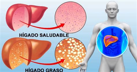 COMO COMBATIR EL HÍGADO GRASO - GANODERMA DXN ~ Dxn Ganoderma Salud y Nutricion