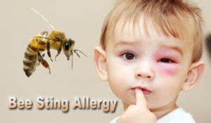 Bee Sting Allergy – Causes And Cures - Health Synonyms