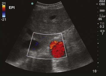 Aortic Ultrasound | Anesthesia Key