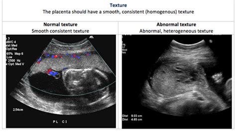 Abnormal Placenta Ultrasound Images