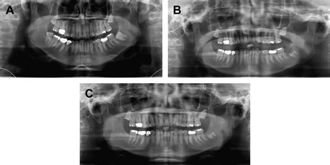 Coronectomy - Atlas of the Oral and Maxillofacial Surgery Clinics of ...