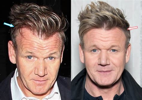 Gordon Ramsay Hair Transplant Before and After in 2022 | Hair ...