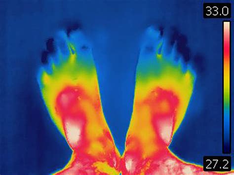 Infrared Thermal Imaging Shows Inflammation in Chronic Nonbacterial ...