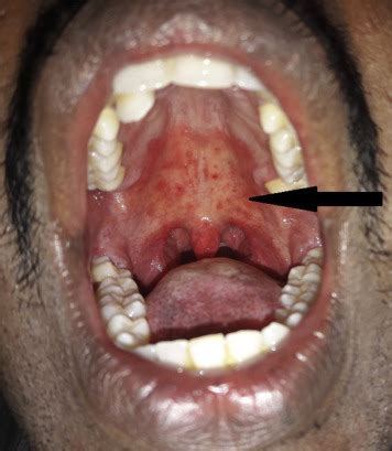 Erythematous Candidiasis - The Journal of Allergy and Clinical ...