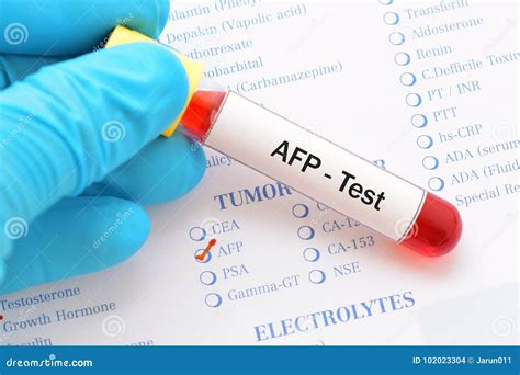 AFP test stock photo. Image of illness, technology, exam - 102023304