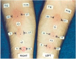 Tuberculosis Skin Test Ruler