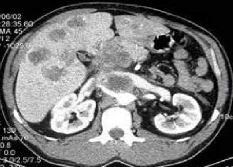 Cancer of the head of the pancreas with liver metastases. | Download ...