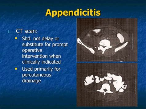 Appendix, Surgery